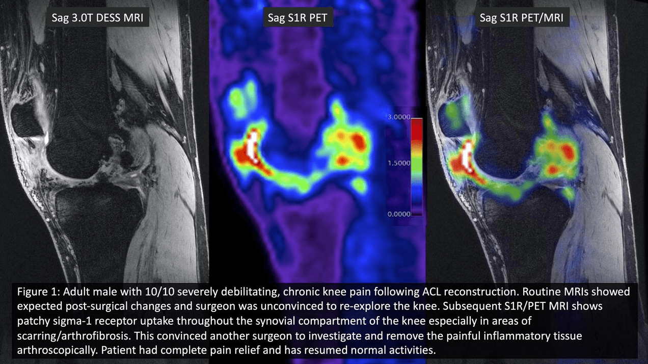 S1R PET/MRI Knee Pain Research